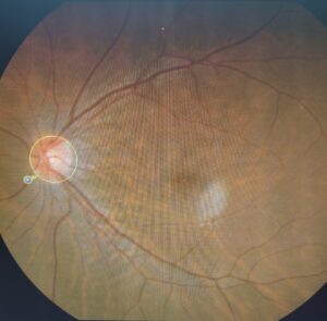 Normal optic disc Glaucoma