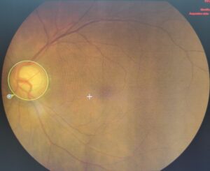 Optic disc of a glaucoma patient
