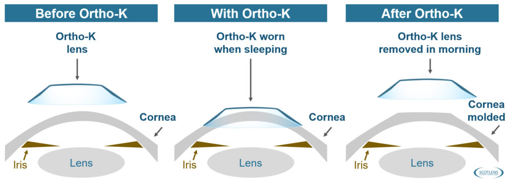 Ortho K Contact Lens